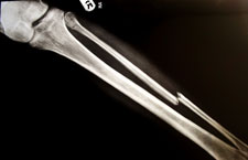 X-ray of a Leg